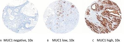 Mucin-1 Protein Is a Prognostic Marker for Pancreatic Ductal Adenocarcinoma: Results From the CONKO-001 Study